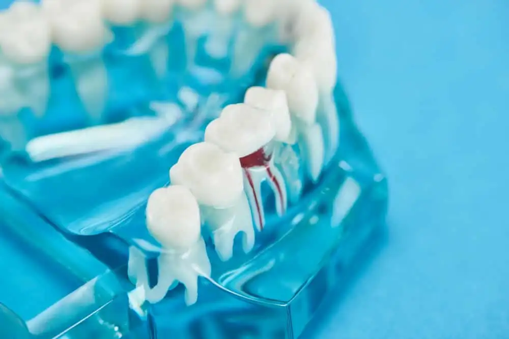 All-on-4 dental implants for full-arch tooth replacement in Queens
