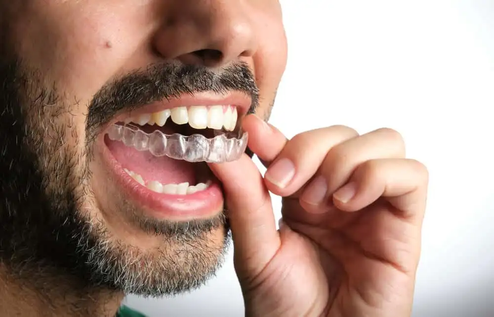 How Invisalign works and how long clear aligner treatment takes in Queens